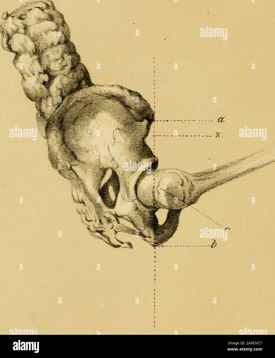 Un trattato sull'eziologia, la patologia e il trattamento delle dislocazioni congenite della testa del femore. Femorum in modo da lanciare la testa di ciascun verso l'alto e un po' verso l'esterno. Queste cause ausiliarie, vale a dire il peso del corpo, il ringhiato growthof dei muscoli interessati e l'azione fisiologica della SINTOMATOLOGIA. 127 i muscoli, prendendo effetto solo dopo liasined vita extra-uterina, tengono prontamente conto della trasposizione, in luxation congenita di chm-s dell'anca-articolazione così come in theother affetti di questa classe, che si verificano in un man-ner graduale, e diventando nel corso del tempo più m. Foto Stock