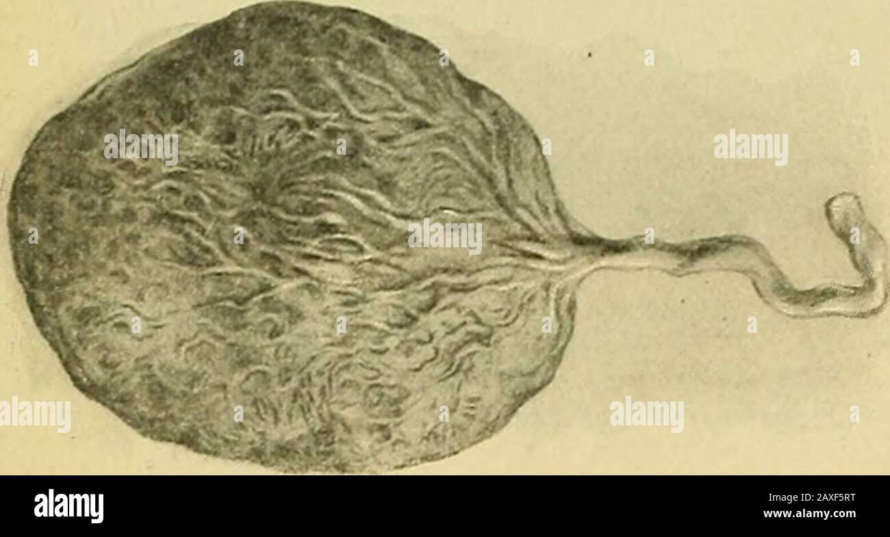 La pratica dell'ostetricia, concepita per l'uso di studenti e professionisti della medicina . Fig. 258.-Placenta in triplette. Tre Masse di Placenta, con un isolatedCotyleddon.-(Ribemont.) Fig. 259. - piccoli accessori di Placenta. (Ribemont-le-page.) 211 212 GRAVIDANZA PATOLOGICA. Centae spuriae). Fino a mezza dozzina di questi organi accessori sono stati trovati in un singolo utero. Queste anomalie sono probabilmente originate in uno dei due modi: I) endometritico. ^ Foto Stock