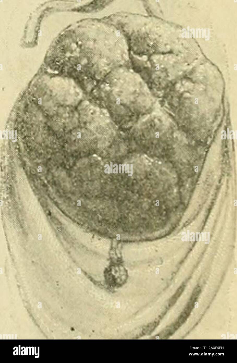 La pratica dell'ostetricia, concepita per l'uso di studenti e professionisti della medicina . Fig. 258.-Placenta in triplette. Tre Masse di Placenta, con un isolatedCotyleddon.-(Ribemont.) Fig. 259. - piccoli accessori di Placenta. (Ribemont-le-page.) 211 212 GRAVIDANZA PATOLOGICA. Centae spuriae). Fino a mezza dozzina di questi organi accessori sono stati trovati in un singolo utero. Queste anomalie sono probabilmente originate in uno dei due modi: I) endometritico Foto Stock