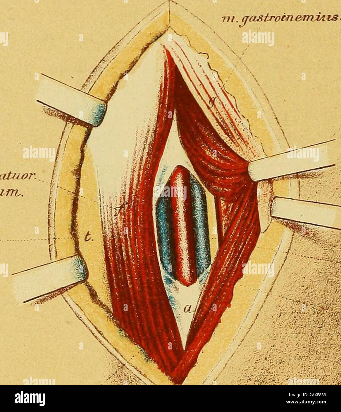 Il manuale del chirurgo sul trattamento dei feriti in guerra : un saggio premio . 4£&7Zgor hcJx^b^riffv^ Tcib.IK m m.flexor jfiiatuar..  i dieritorunv. % tii. (Justroin&miAis. RH/ia. T- f Tterous tibialis. Twsoleus. AjLO-nearosi. M Piastra XX.Ligature dell'arteria tibiale posteriore sopra il centro della gamba (destra). 1. L'incisione cutanea ha una lunghezza di 8 - 10cm e ad una distanzadi lcm dal bordo interno della tibia. 2. Dopo la divisione della fascia, il bordo della gastrocnemiusè tirato indietro, e i soleni separati dalla tibia: L'apertura è allargata con la punta del dito, Foto Stock