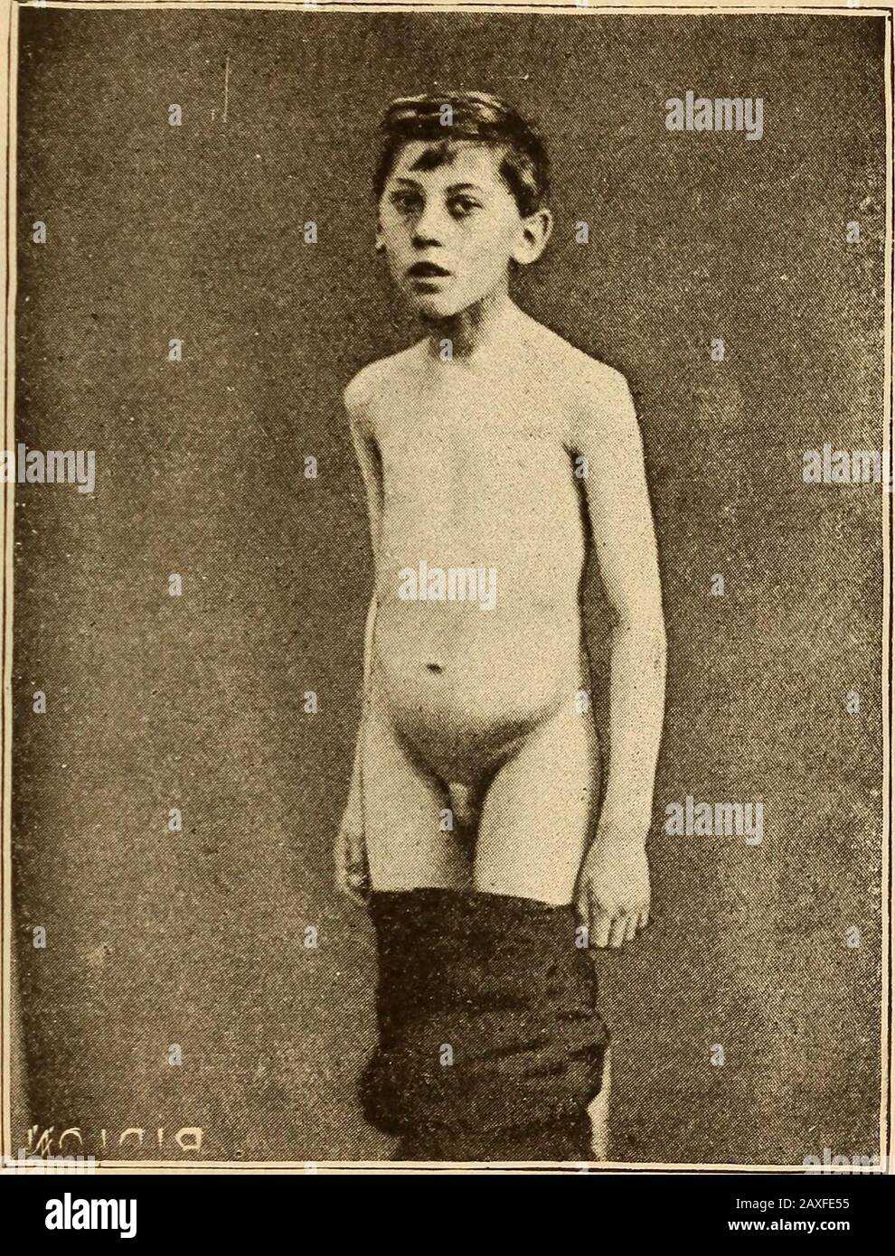 Lezioni di chirurgia ortopedica . Fig. 25.-spondilite lombare superiore con ascesso di psoas che si presenta sulla tliethigh nella posizione usuale. Spondilite nella regione cervicale superiore, e tuttavia, in molti casi, la diagnosi può essere fatta a vista. Inwry-collo, il mento punta lontano dal muscolo prominentsterno-mastoide; nella spondilite, punta verso 43 quel muscolo, se soltanto un muscolo è prominente. Inspiondilite, i movimenti della testa sono restrictedin tutte le direzioni; nel torticollis, solo in una direzione, quella direzione che mette il muscolo accorciato sul thestretch. Fig. 26.-spondilite lombare superiore Foto Stock