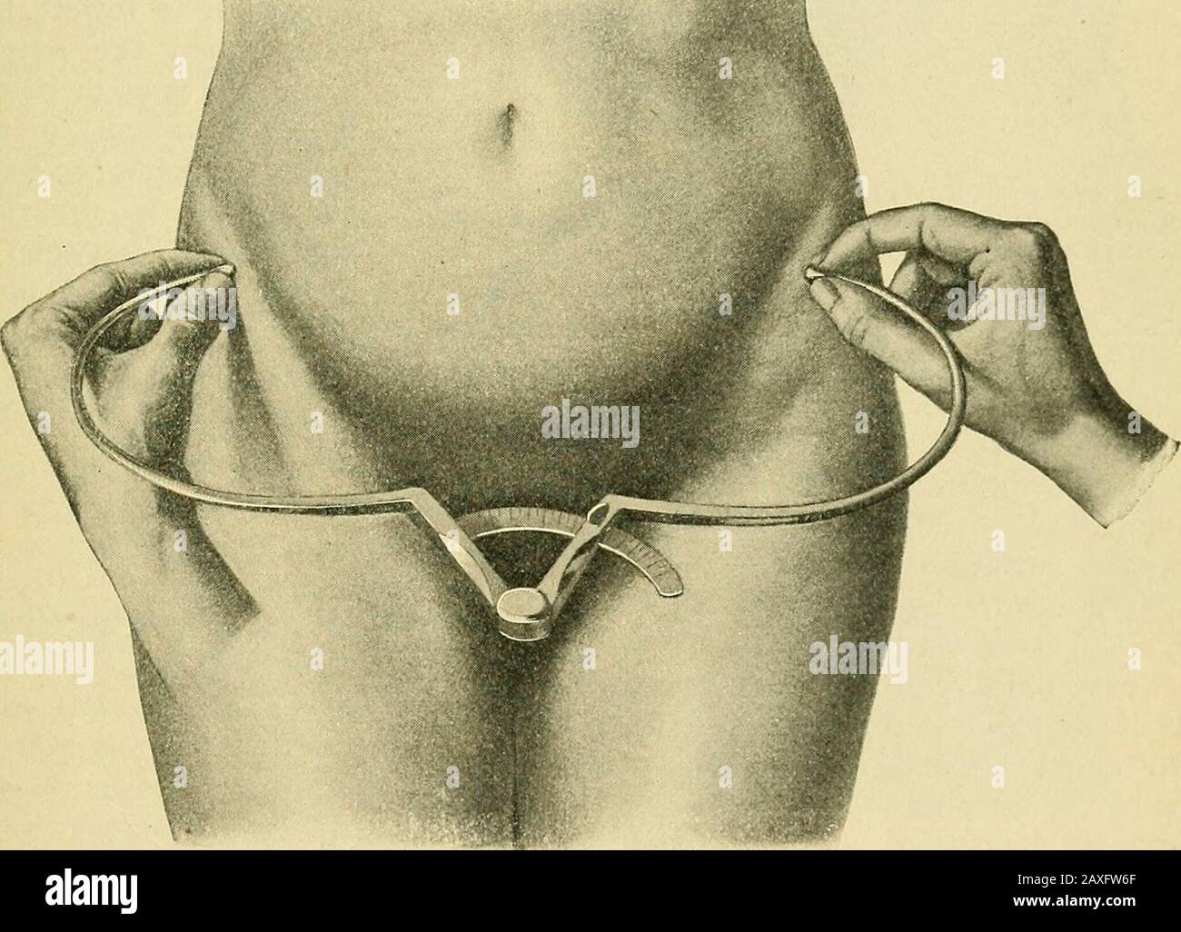 La pratica dell'ostetricia, concepita per l'uso di studenti e professionisti della medicina . Fig. 203.-Misurare Il Diametro interspinale con il Pelvimetro Baudelocqub. Tra le creste iliache, e viene misurato tra le porzioni più prominenti (Fig. 204). Nei pelfi normali questo diametro varia da 26,7 a 29,1 cm. 3. Tra I Grandi Trocantori (Fig. 209).- Questo diametro è la distanza maggiore tra le superfici esterne dei grandi trocantori della femora.In condizioni normali misura 31 cm, ma può anche essere II^ 164 GRAVIDANZA FISIOLOGICA. Foto Stock