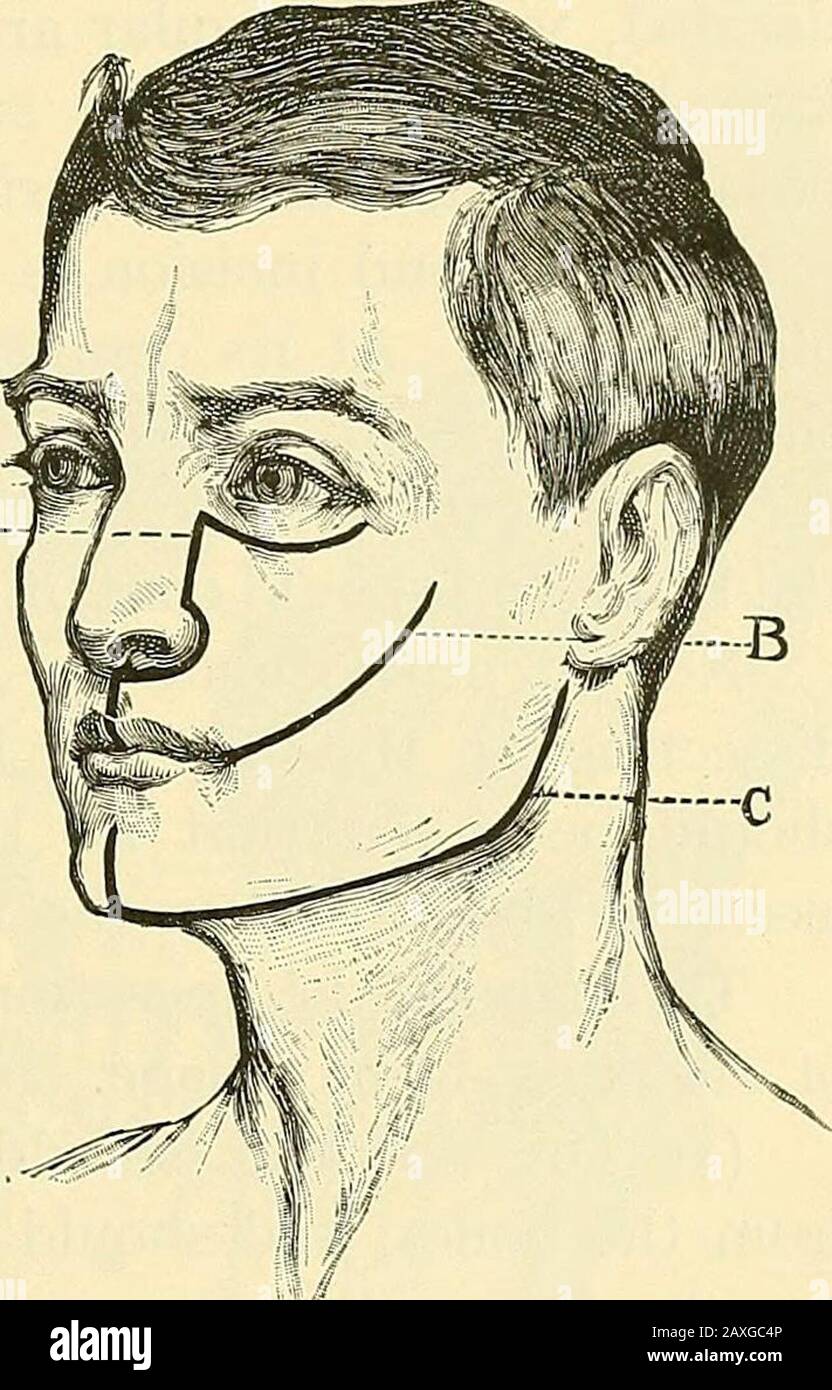 Un manuale di chirurgia operativa. Il paziente si trova sulla schiena, con la testa e le spalle ben sollevate. Theface, se il paziente è amale, avrebbe dovuto essere rasato al-ready. La testa si è isturnata al lato del suono. Hewitt E Sheild (Med.-Chir. Trans., 1896, pag. 18)consigliare la completa lateralposizione del paziente, con la testa sul bordo deletabile e il viso rivolto verso il pavimento. I Bloodscolo lontano prontamente in thisposition senza rischio di itsenting la trachea. Il chirurgo si trova sul lato destro del paziente nel trattare con entrambi i lati della mandibola. Il capo assistente dovrebbe prendere il suo posto Foto Stock