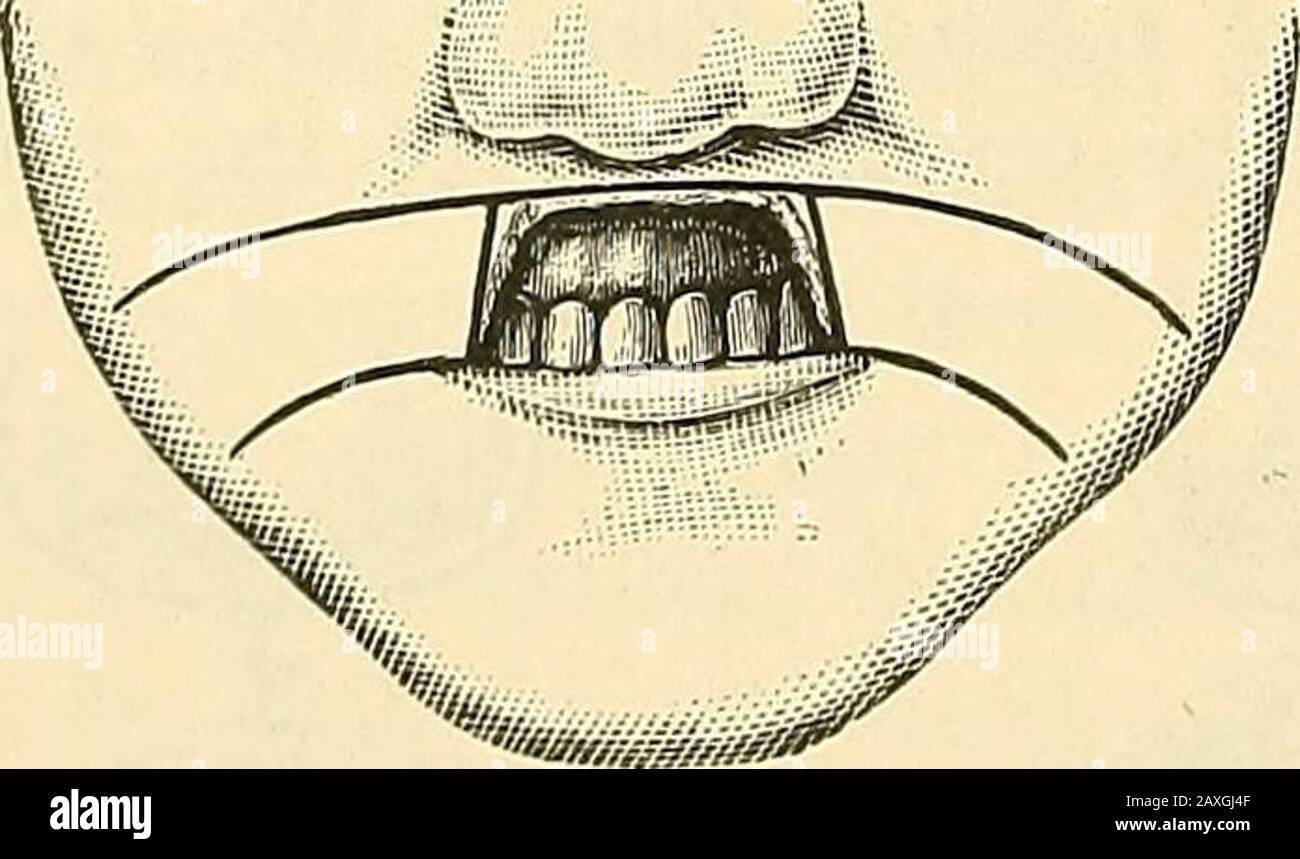 Un manuale di chirurgia operativa . FIG. 271.- OPERAZIONE SERRES PER IL RIPRISTINO DELL'ANGOLO DELLA BOCCA. Quando i tessuti così circoscritti sono stati asportati, i edgesdelle ferite sono uniti come mostrato in Fig. 271. Gli integramenti adiacenti vengono disegnati insieme, un'incisione verticale e trasversale a cui si ottiene il risultato. 2. Tutto Il Labbro superiore deve essere ripristinato.-(a) Operazione con Lembi Laterali (Metodo Szymanowskis).- i lembi laterali di tutta la larghezza del labbro sono tagliati dalla guancia sull'eachside. Le loro estremità esterne sono curvate verso il basso, in modo da alleviare. Foto Stock