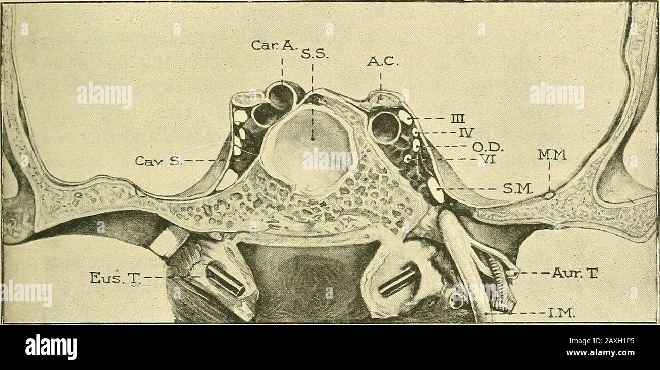 Un manuale di chirurgia operativa . r maxillarynerve deve essere chiaramente definito come passa attraverso il foramenovale, e a questo punto l'arteria meningea centrale è alostsure per richiedere la divisione. Quest'ultima è una delle fasi più difficili dell'operazione, poiché è difficile passare un aneurisma-ago intorno al vaso a questa profondità. Piccoli pezzi di porta spugnai fini sono usati per controllare lo spurgo, ed è necessarioattendere di tanto in tanto fino a che cessa. Nel legare il chap meningeo, in] ESCISSIONE DEL GANGLIO di GASSERIAN, 81 nodi doppi dell'arteria di seta fine dovrebbero essere usati ed il v Foto Stock