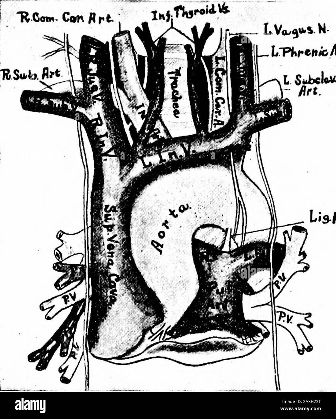 Un manuale di anatomia. I tributari sono le vene farreniche, surrenali, renali, spermatiche, ovariche, lombari ed epatiche inferiori. (Vedere La Fig. 178.) le vene fileniche inferiori (due) restituiscono una parte del sangue dal diaframma. Le vene soprarenali (due) restituiscono il sangue da quelle ghiandole. Le vene renali (due) restituiscono il sangue dai reni. La vena renale estrema ha una lunghezza di circa 2,5 cm (i pollici) e la sinistra è di 7,5 cm (about3 pollici). 248 IL SISTEMA VASCOLARE DEL SANGUE Le vene lombari sono quattro coppie di vene che corrispondono alle quattro coppie di arterie lombari. La spermatica, o testicula Foto Stock