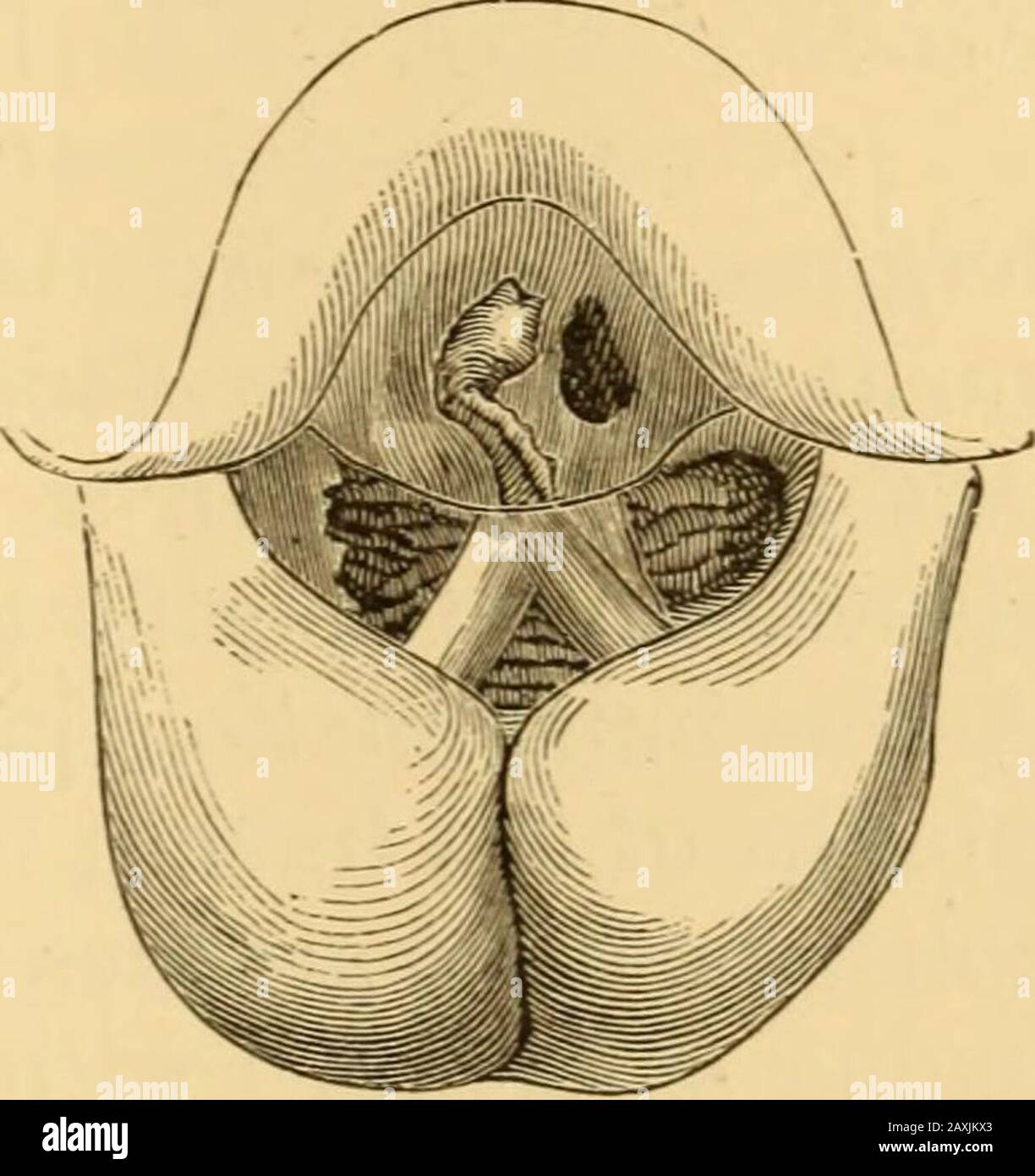 Malattie della gola e dei passaggi nasali; guida alla diagnosi e al trattamento degli affetti della faringe, del sofago, della trachea, della laringe e delle narici . Fig 120.-(Edema della laringe nella tubercolosphthisis, con ulcerazione centrale della faceof epiglottis linguale e cicatrice lineare, marcatura della previsione del suo bordo libero. Fig. 121 – (Edema della laringe con ulcerazione, in quest'ultimo stadio del fthisis. (Il paziente per-ha sparito improvvisamente da soffocamento, perché trache-otomia era stata declinata.) le pareti laterali ed altre strutture cedematose sono così sopra-posate con muco, pus e detritus che nessun defini Foto Stock