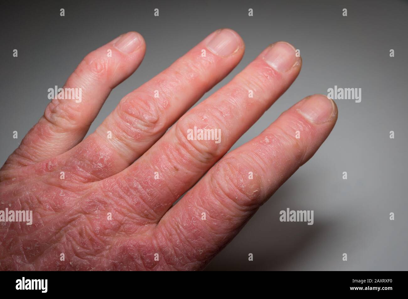 Mano di un paziente psoriasi primo piano. Artrite psoriasica. Deformazione e infiammazione delle articolazioni sulla pelle. Foto con vignettatura scura.fuoco morbido. Foto Stock