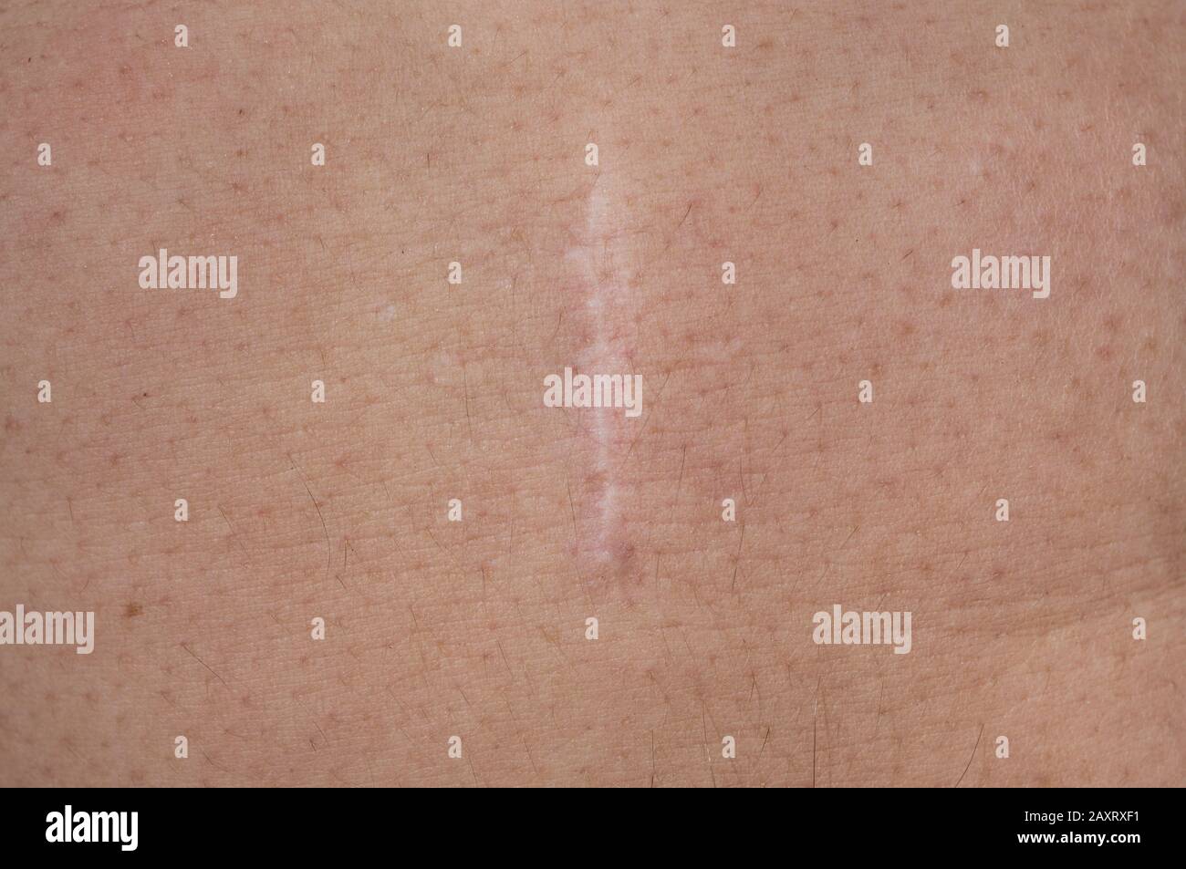 Primo piano di una cicatrice cheloide postoperatoria sulla pelle dell'addome di un uomo. Foto Stock