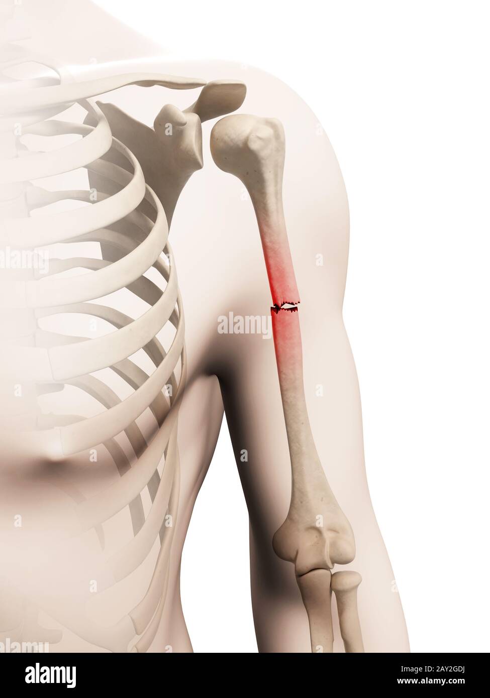 Illustrazione medica di borken osso di braccio Foto Stock