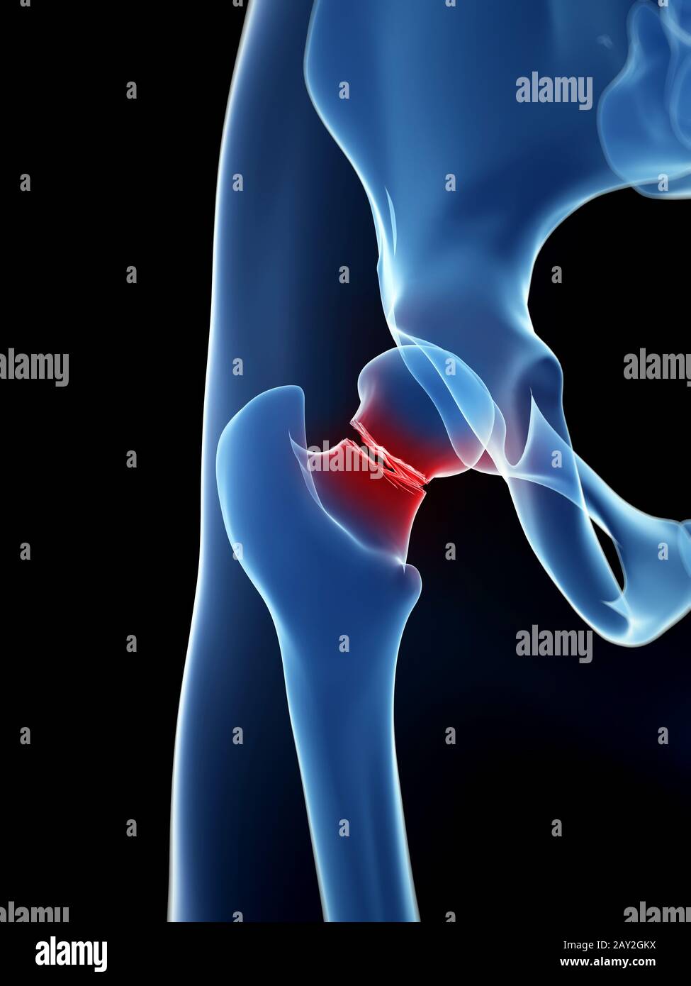 Illustrazione medica di anca rotto Foto Stock