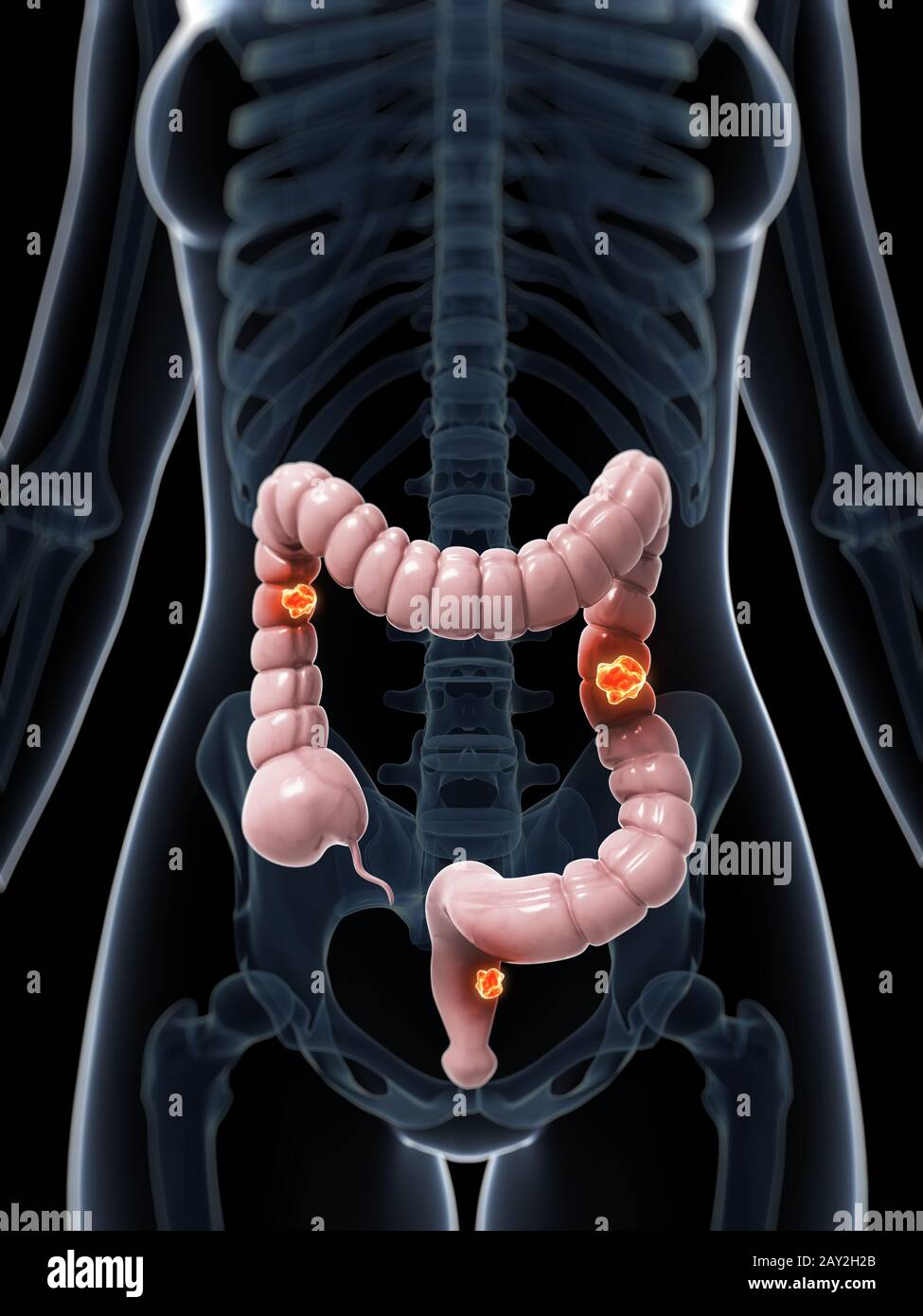 3d reso illustrazione di cancro al colon Foto Stock