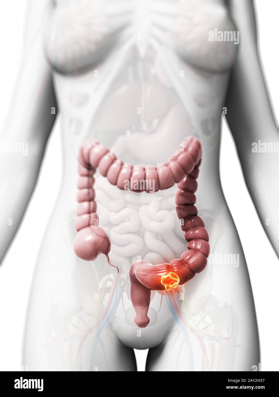 3d reso illustrazione di cancro al colon Foto Stock