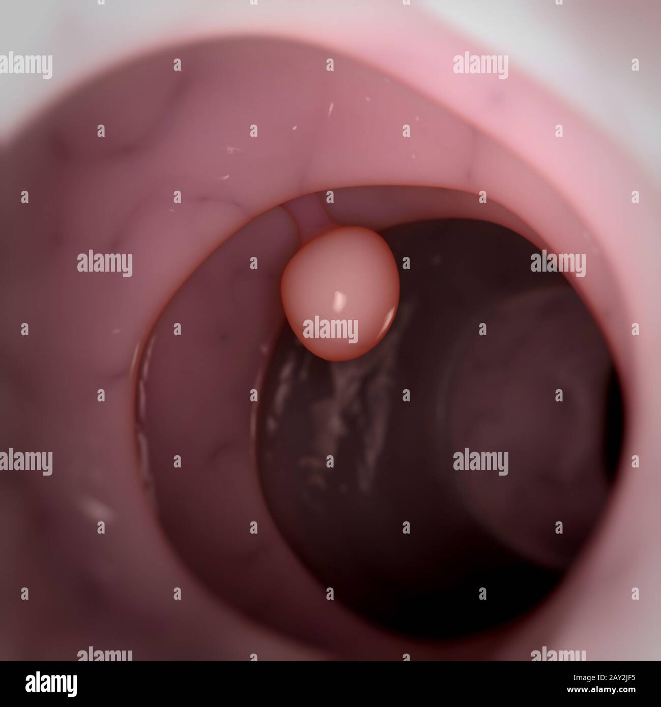 illustrazione 3d medica - polipo del colon Foto Stock