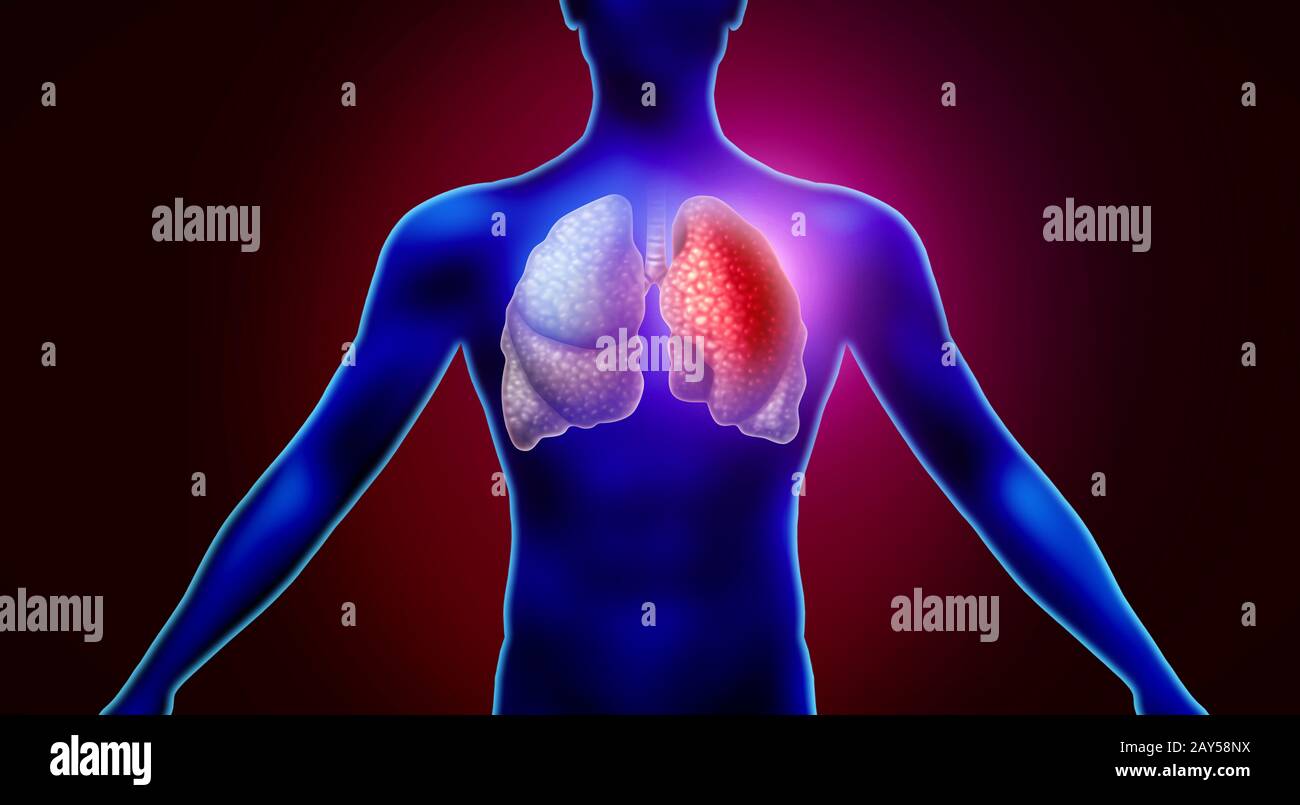 Infezione dei polmoni umani e infiammazione respiratoria come focolaio di influenza influenzale o polmonite e malattia infiammatoria polmonare. Foto Stock
