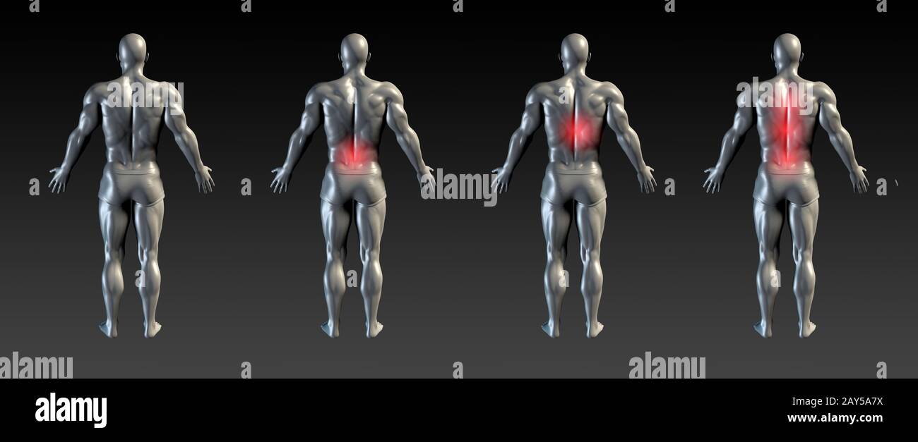 Lesioni della colonna vertebrale Foto Stock