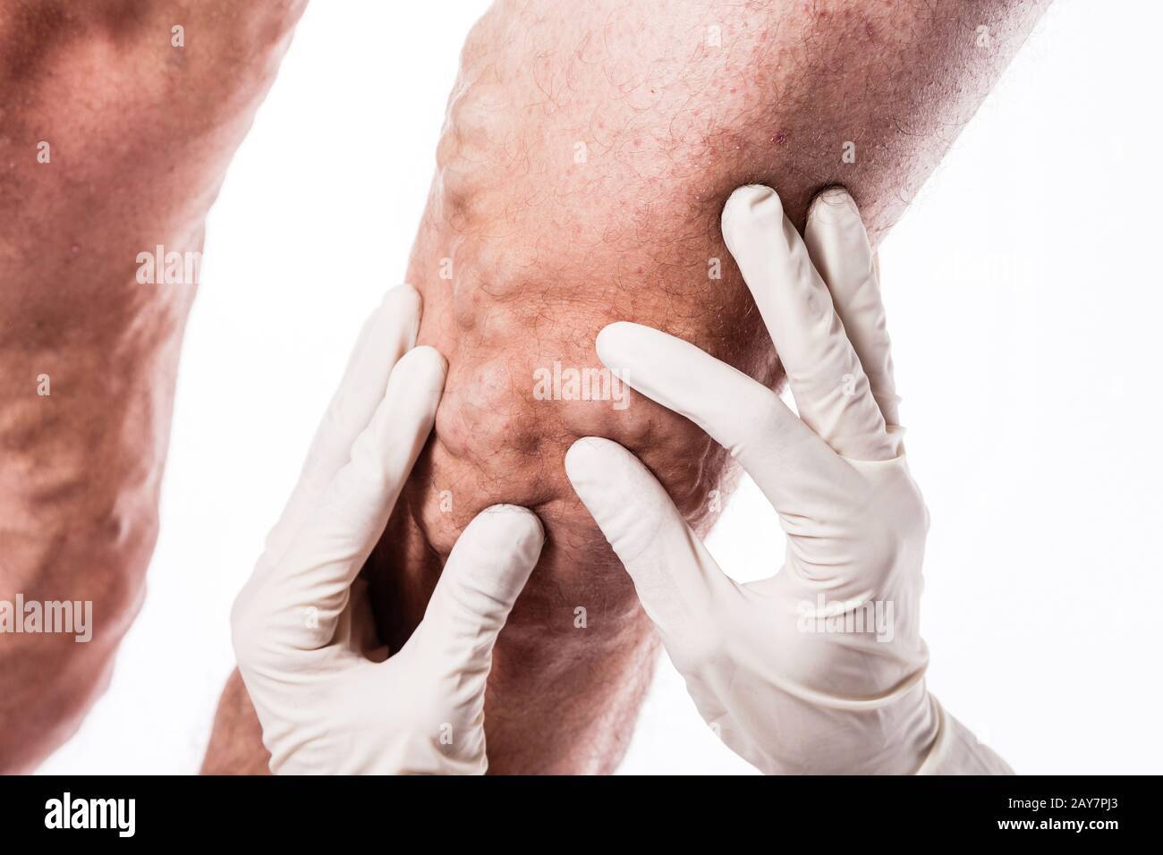 Il medico nei guanti medici esamina una persona con vene varicose o Foto Stock