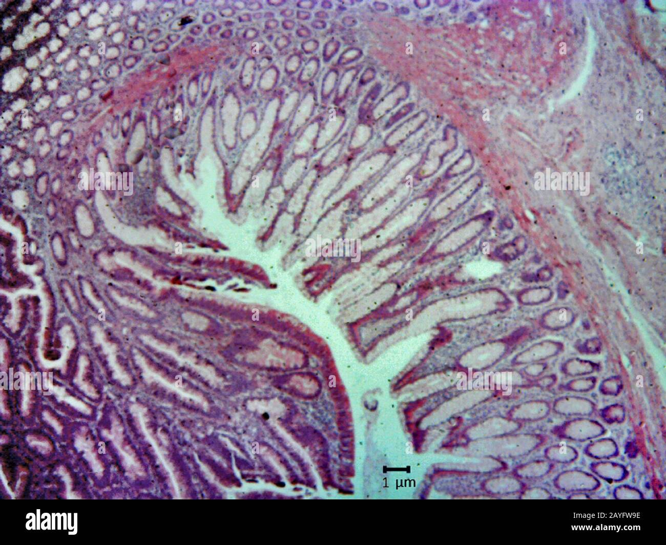 taglio istologico del tessuto del cancro del colon, 200 x Foto Stock