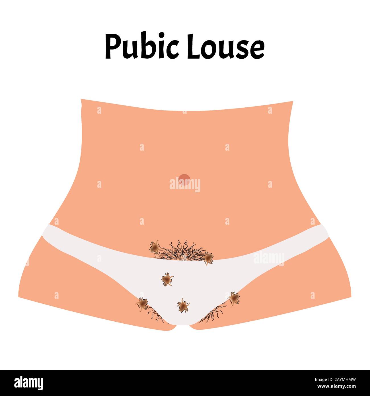 Malattie parassitarie di Phtiriasis. Pediculosi pubis. Struttura di ghiaccio pubico. Malattie sessualmente trasmissibili. Infografiche. Illustrazione del vettore attivata Illustrazione Vettoriale