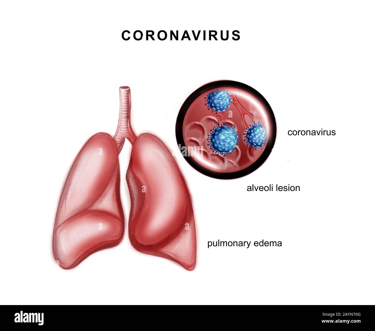 Illustrazione dei polmoni umani e del coronavirus Foto Stock