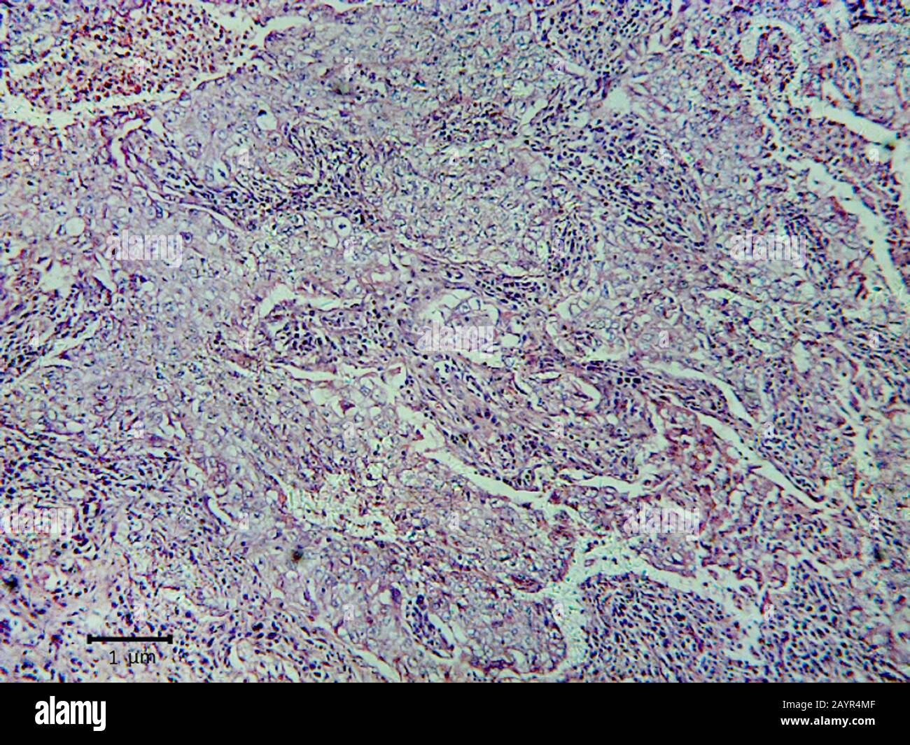 taglio istologico del tessuto di cancro polmonare, 500 x Foto Stock
