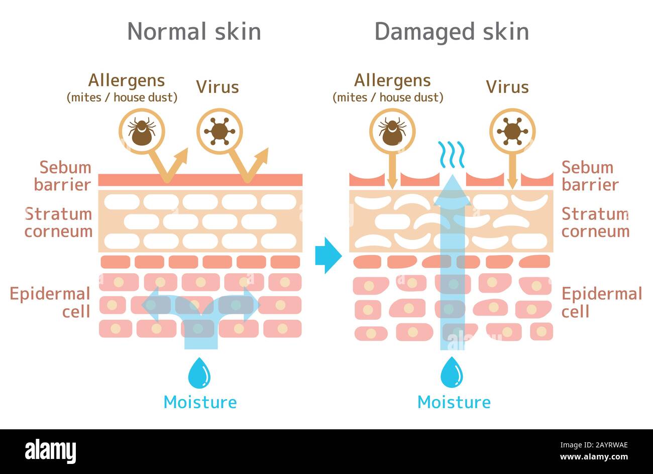 Vista in sezione della figura skin.Comparison dell'effetto di protezione tra pelle sana e pelle ferita. Illustrazione Vettoriale