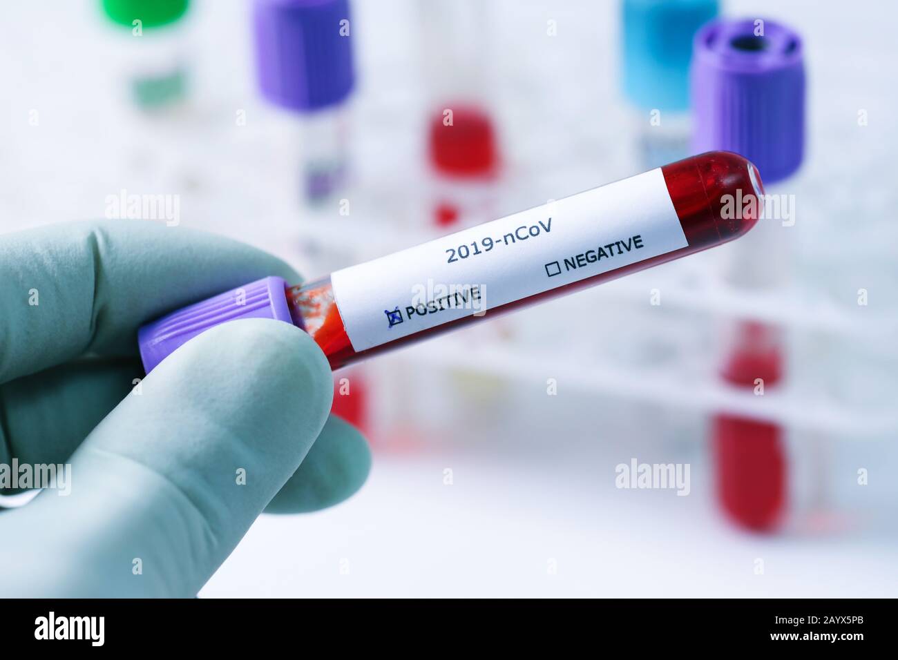 provetta per campioni di sangue in mano con test di coronavirus positivo Foto Stock