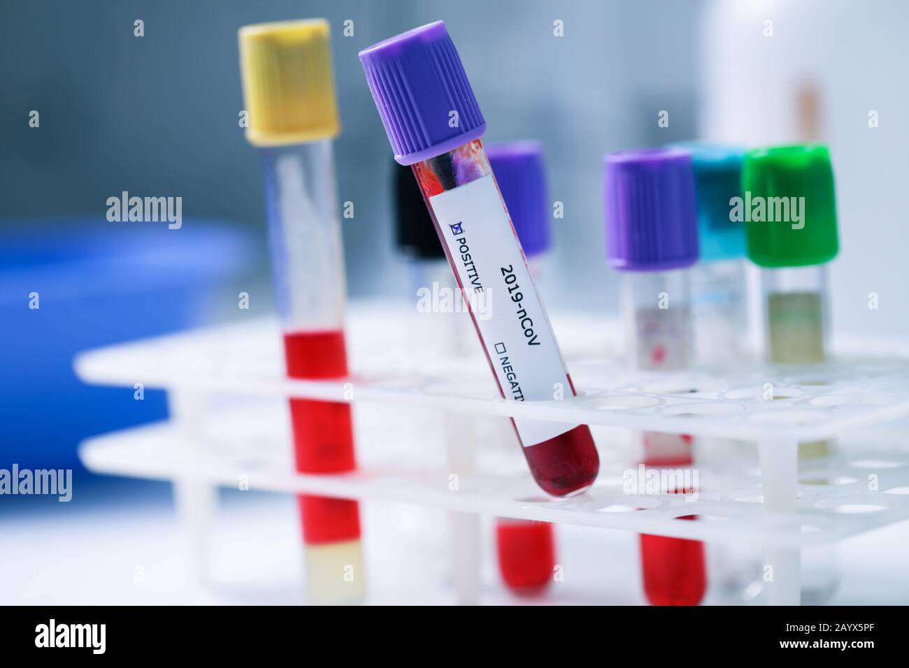 provetta per campioni ematici con test positivo di coronavirus in laboratorio Foto Stock