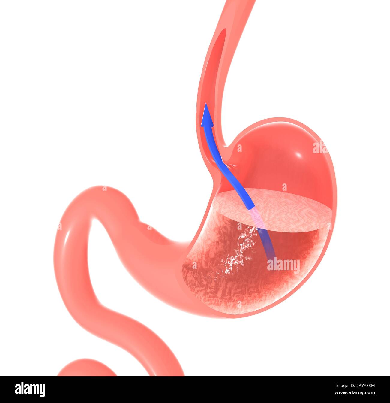 3D illustrazione dell'interno dello stomaco che mostra il riflusso del cibo. Attraverso l'esofago, con una freccia che punta al movimento. Foto Stock