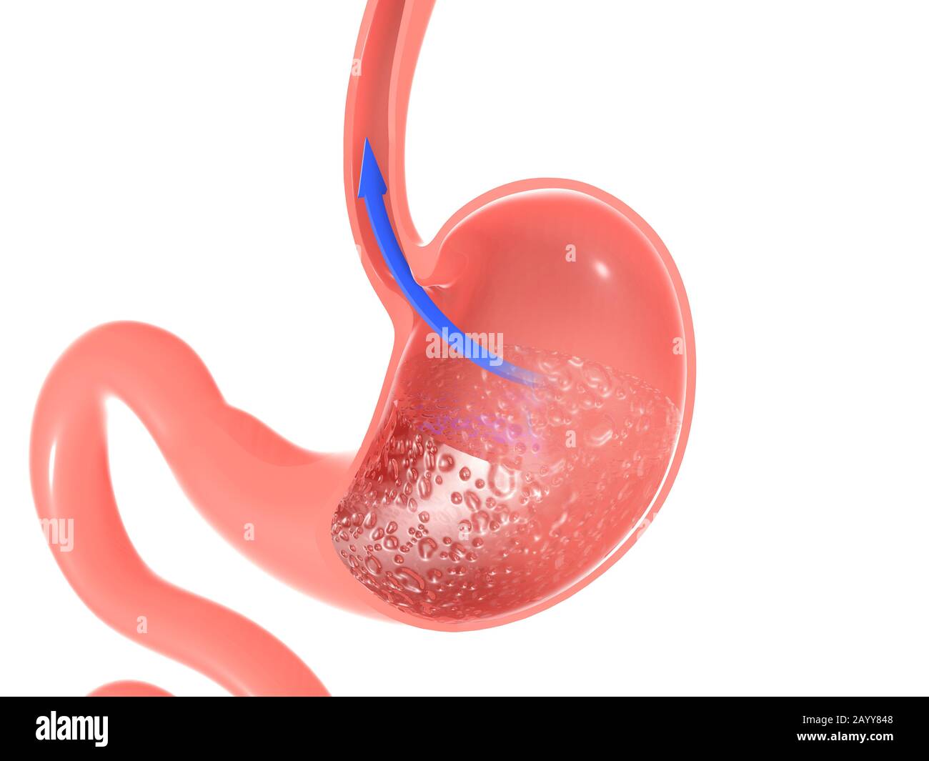3D illustrazione dell'interno dello stomaco che mostra il riflusso del cibo. Attraverso l'esofago, con una freccia che punta al movimento. Foto Stock