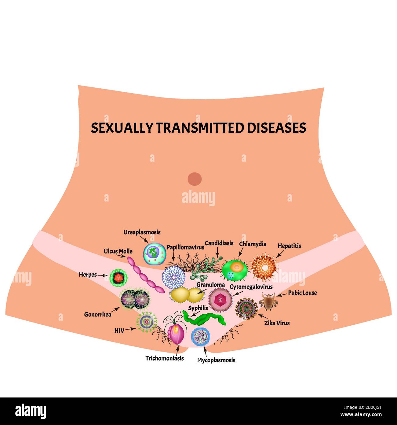 Infezioni virali e batteriche. Malattie sessualmente trasmissibili. Infografiche. Illustrazione vettoriale su sfondo isolato. Illustrazione Vettoriale