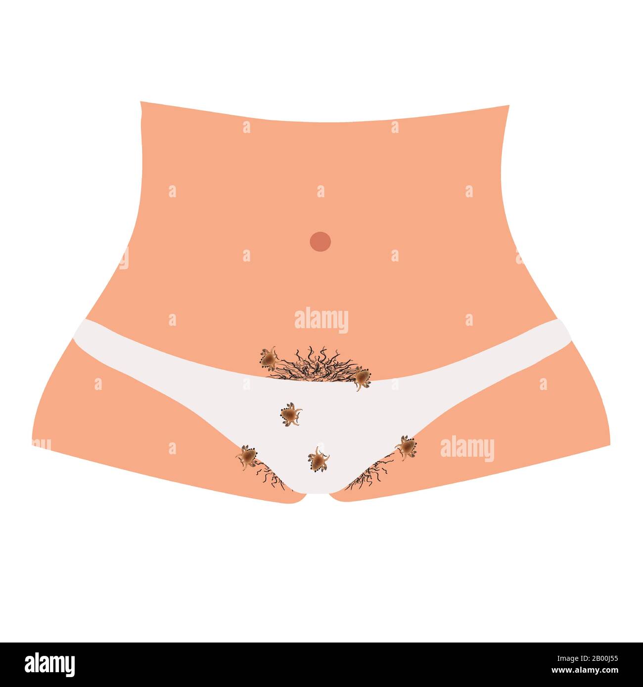 Malattie parassitarie di Phtiriasis. Pediculosi pubis. Struttura di ghiaccio pubico. Malattie sessualmente trasmissibili. Infografiche. Illustrazione del vettore attivata Illustrazione Vettoriale