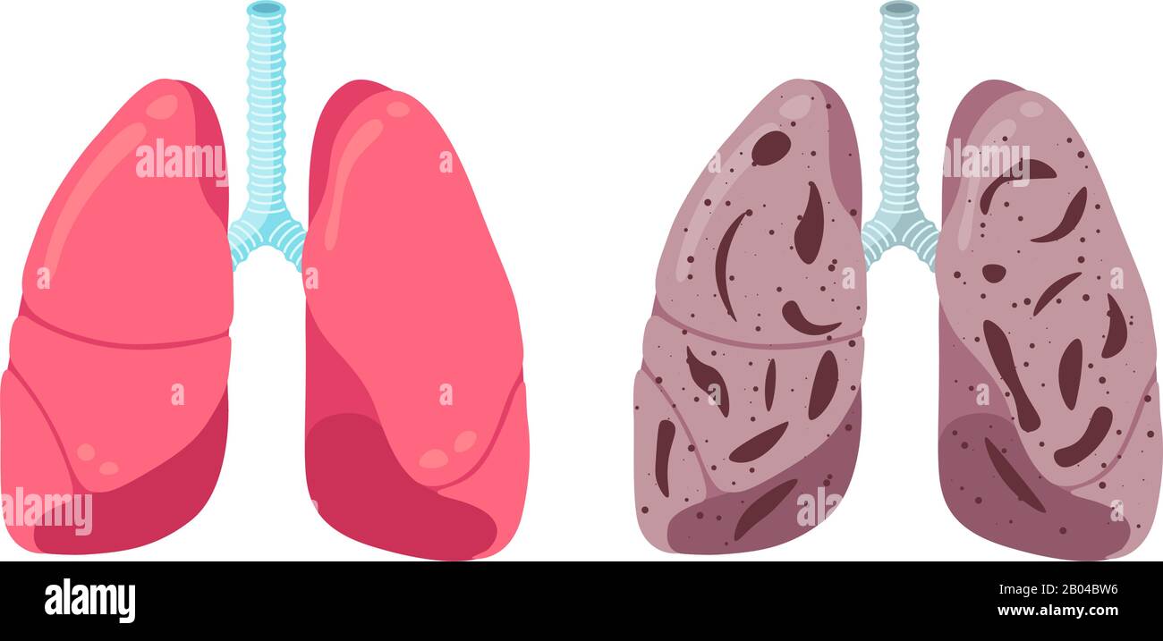 Polmoni sani e malsani confrontano il concetto. Apparato respiratorio umano organo interno forte e polmonite infiammazione. Illustrazione del vettore anatomico delle condizioni mediche della respirazione sanitaria Illustrazione Vettoriale
