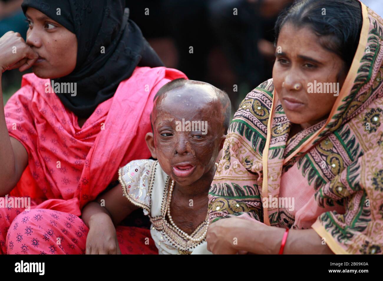 I sopravvissuti agli acidi prendono parte a un programma di sensibilizzazione contro la violenza acida alla vigilia della Giornata internazionale della donna del 2011, a Dhaka, in Bangladesh. 7 Marzo 2011. Foto Stock