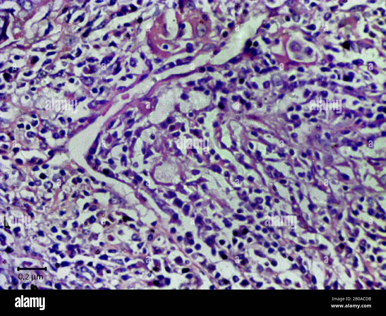 taglio istologico di tessuto di cancro polmonare, 2000 x Foto Stock