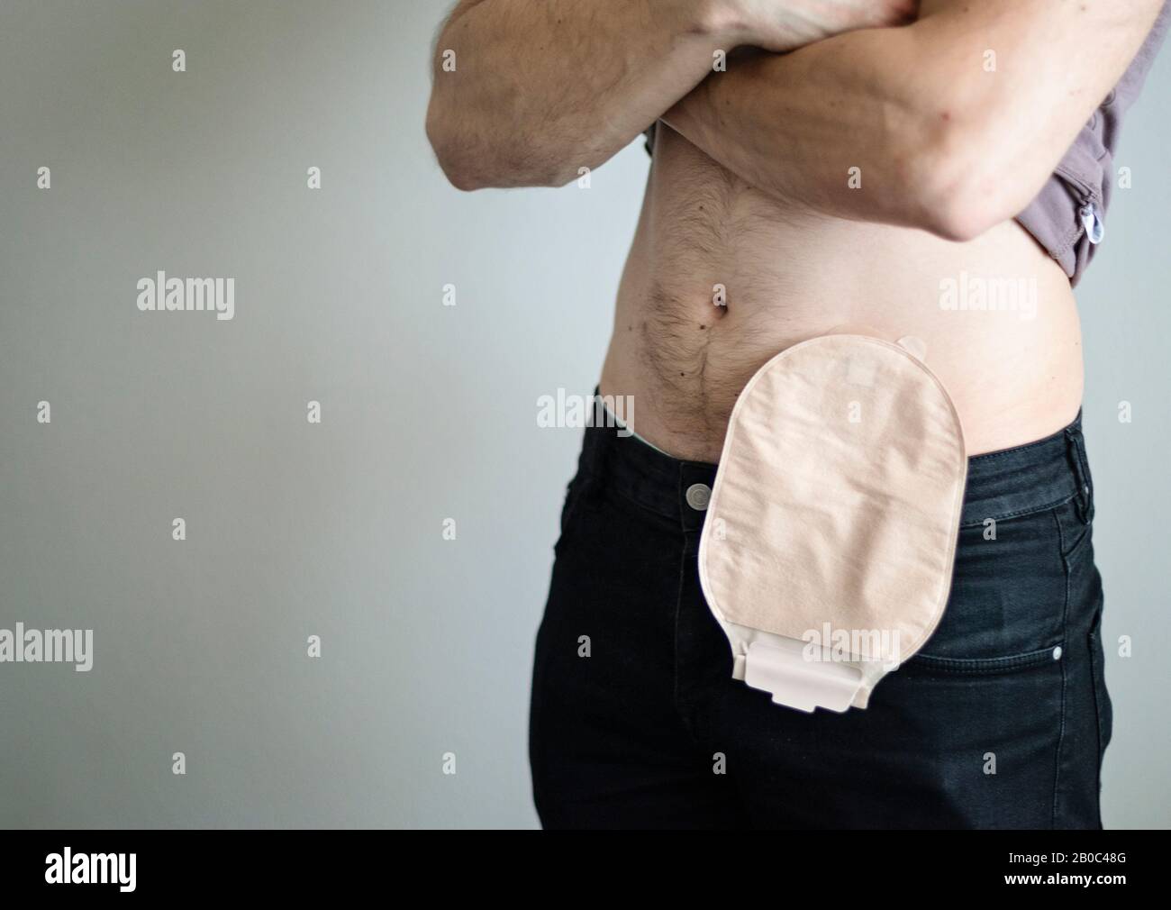 Vista frontale sul sacchetto di colostomia attaccato al paziente umano, tema medico. Custodia per ostomia color pelle da vicino. Trattamento chirurgico del cancro del colon. Spazio di copia. Foto Stock