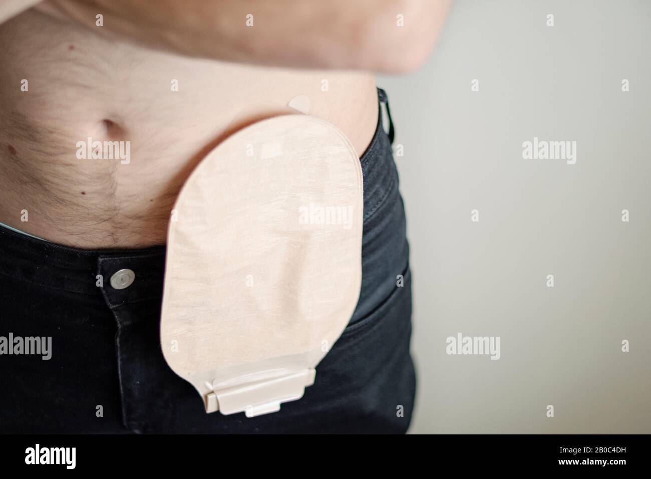 Vista frontale sul sacchetto di colostomia attaccato al paziente umano, tema medico. Messa a fuoco selettiva sul colore della pelle ostomia sacchetto primo piano. Chirurgia del cancro del colon curmen Foto Stock
