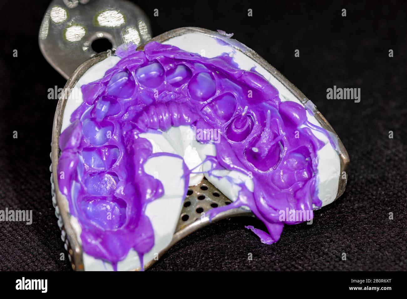 fabbricazione ed installazione di perni e impronte dentali in odontoiatria. Il processo di trattamento dei denti decaduti dal dentista Foto Stock