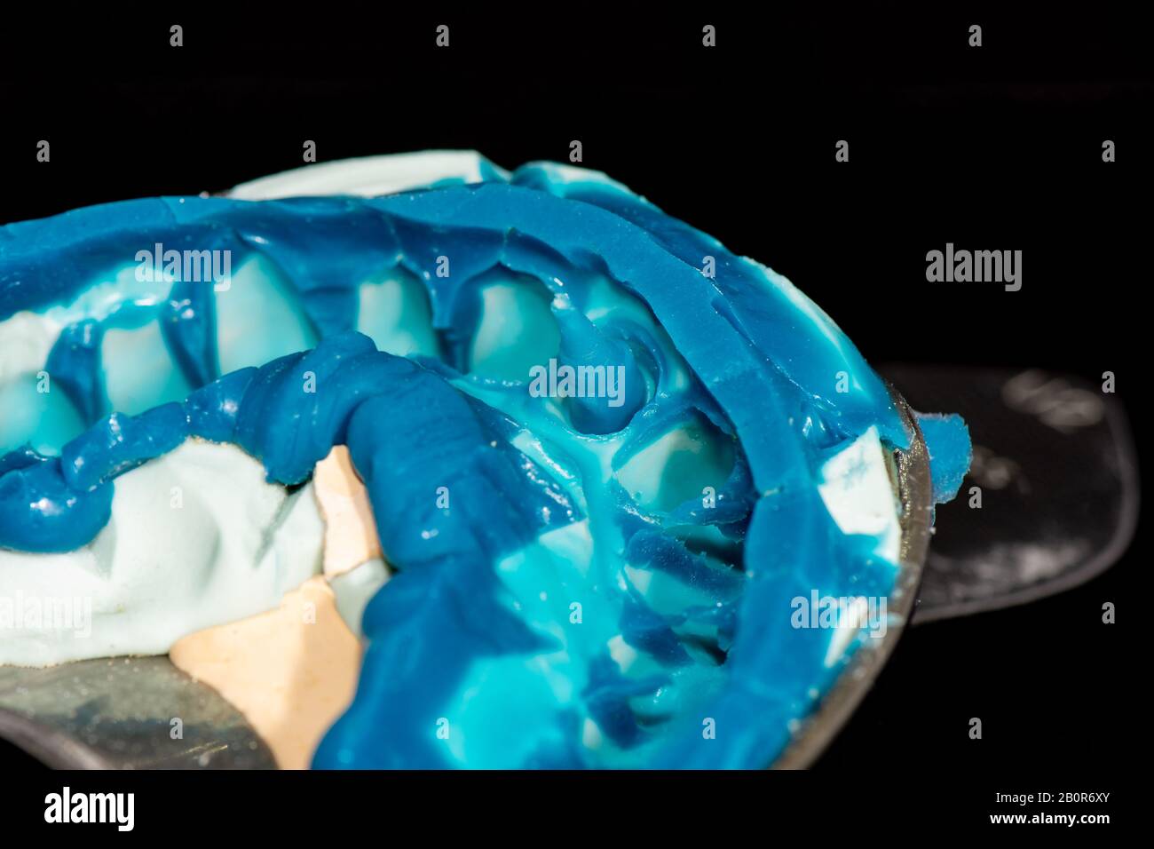 fabbricazione ed installazione di perni e impronte dentali in odontoiatria. Il processo di trattamento dei denti decaduti dal dentista Foto Stock