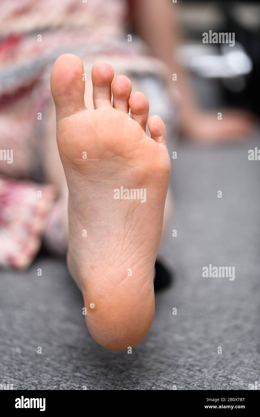 Verruca plantare, verrucas ai piedi di un bambino. Un decagio causato dal papillomavirus umano e spesso diffuso a docce comunali. Foto Stock