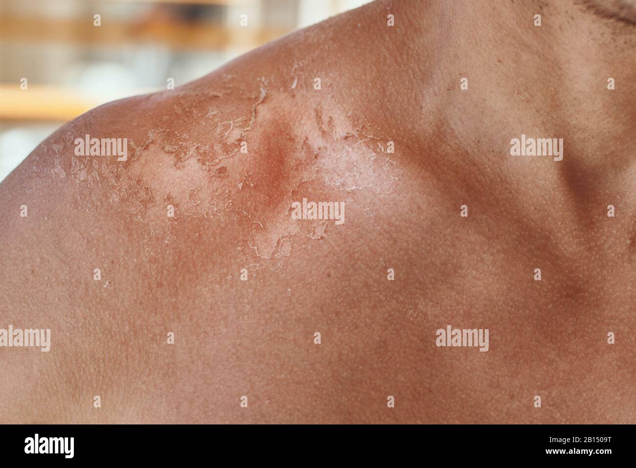 Scottate sulle spalle degli uomini. Spalle con pelle ferita dal sole bruciarsi, closeup Foto Stock