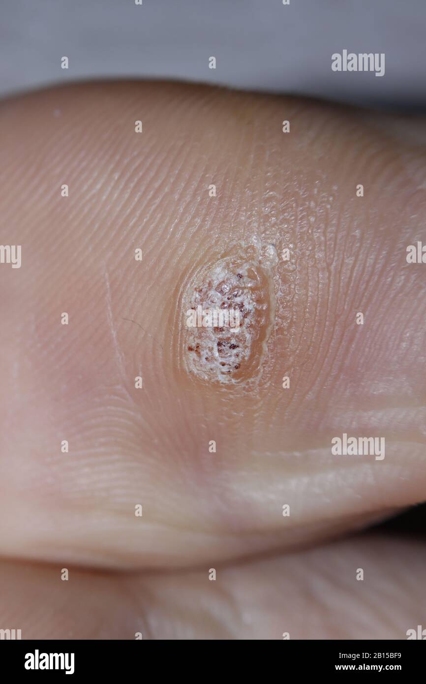 HPV colpo di primo piano di una verruca plantare sul fondo della punta grande causato dal papillomavirus umano. Foto Stock