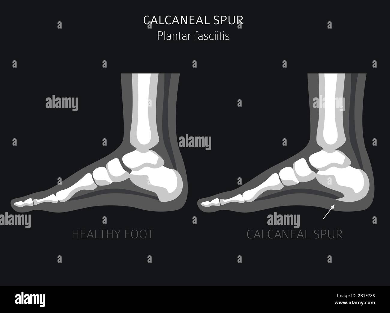 Sperone di calcare. Fasciitis plantar insieme. Raccolta di infografiche per disinfestazione medica. Illustrazione del vettore Illustrazione Vettoriale