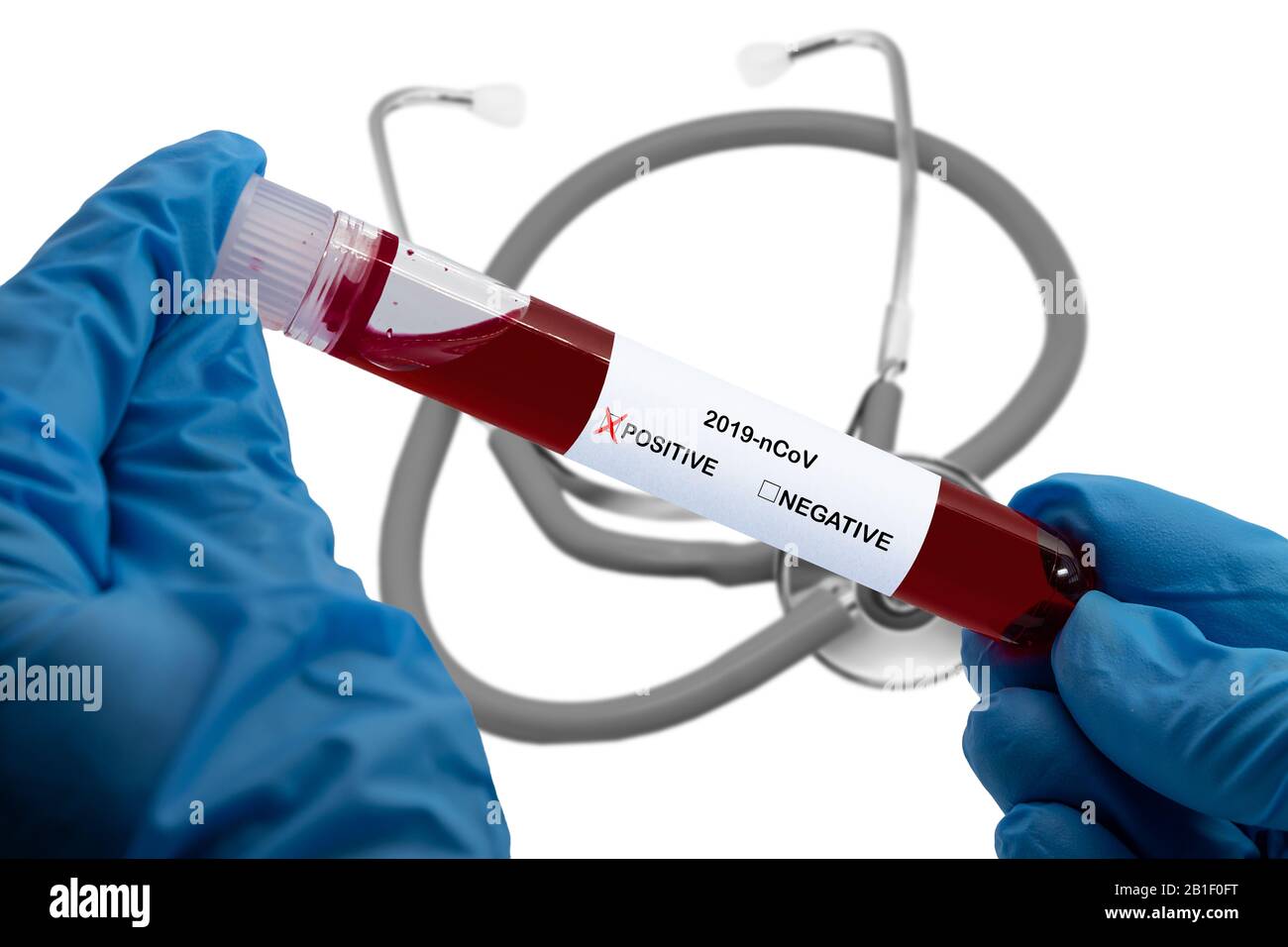 Le mani trattengono il campione di sangue in una provetta sottovuoto con analisi Positiva di Coronavirus 2019-nCoV, isolata su bianco Foto Stock