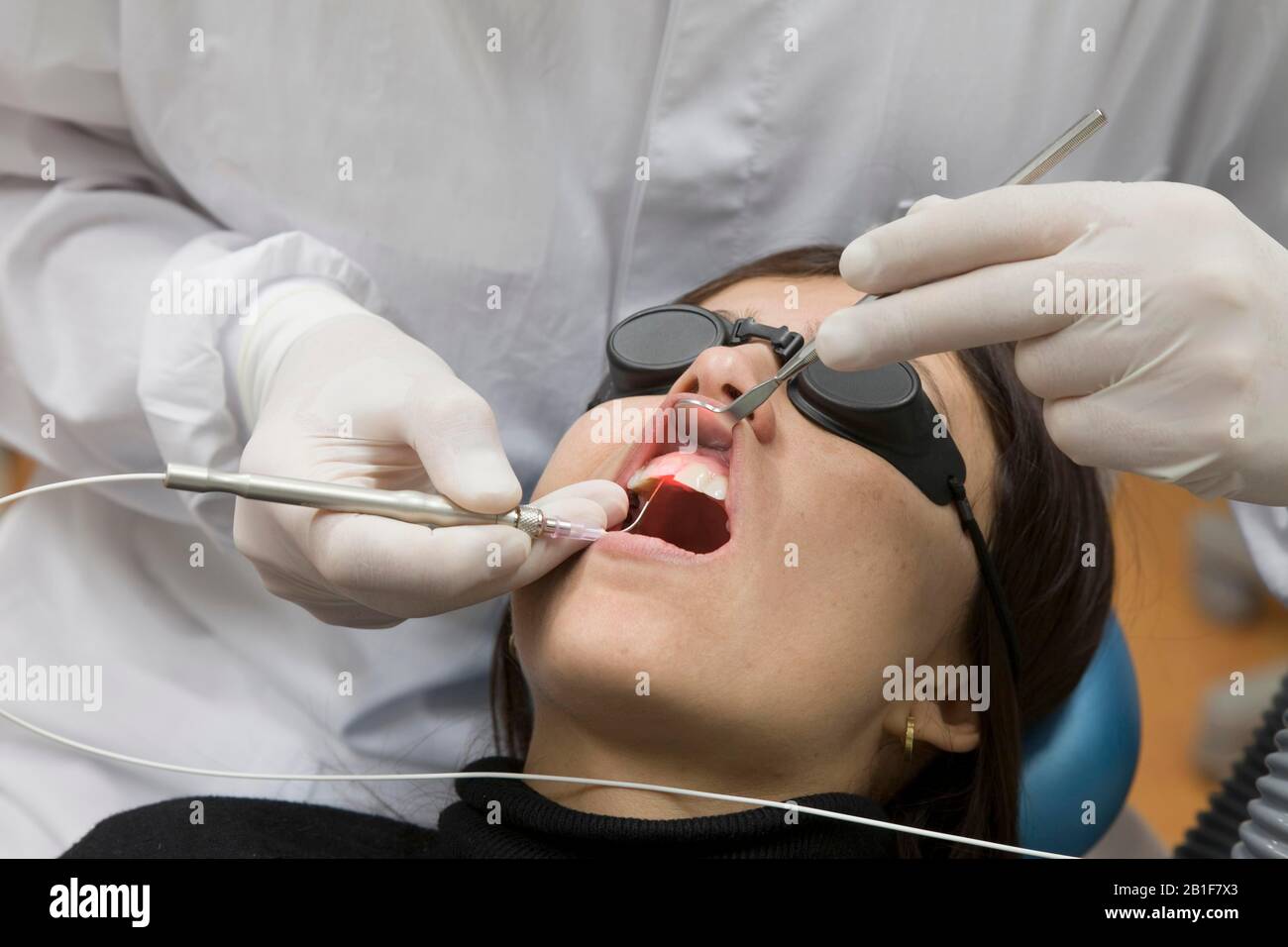 Trattamento dentale con laser, tecnologia laser, Germania Foto Stock