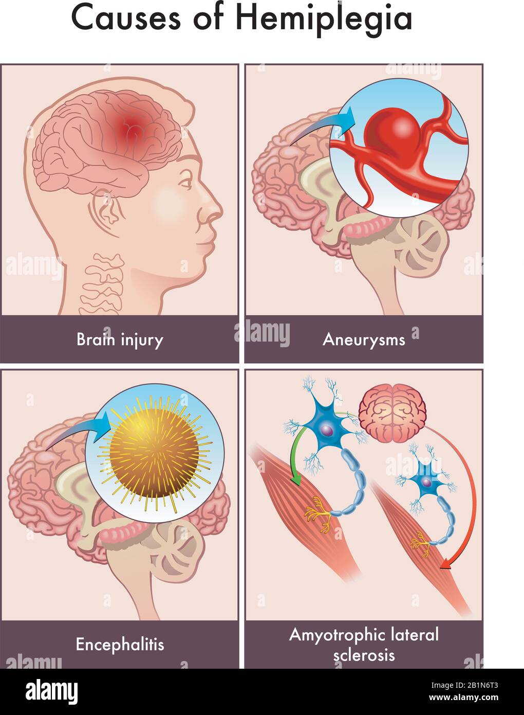 Illustrazione medica delle cause dell'emiplegia, tra cui lesioni cerebrali, aneurismi, encefalite e sclerosi laterale amiotrofica. Illustrazione Vettoriale