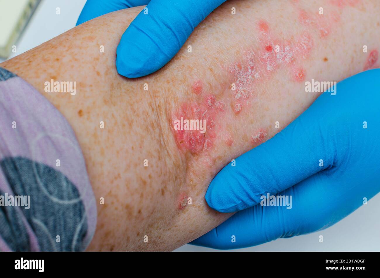 Malattie della pelle immagini e fotografie stock ad alta risoluzione - Alamy