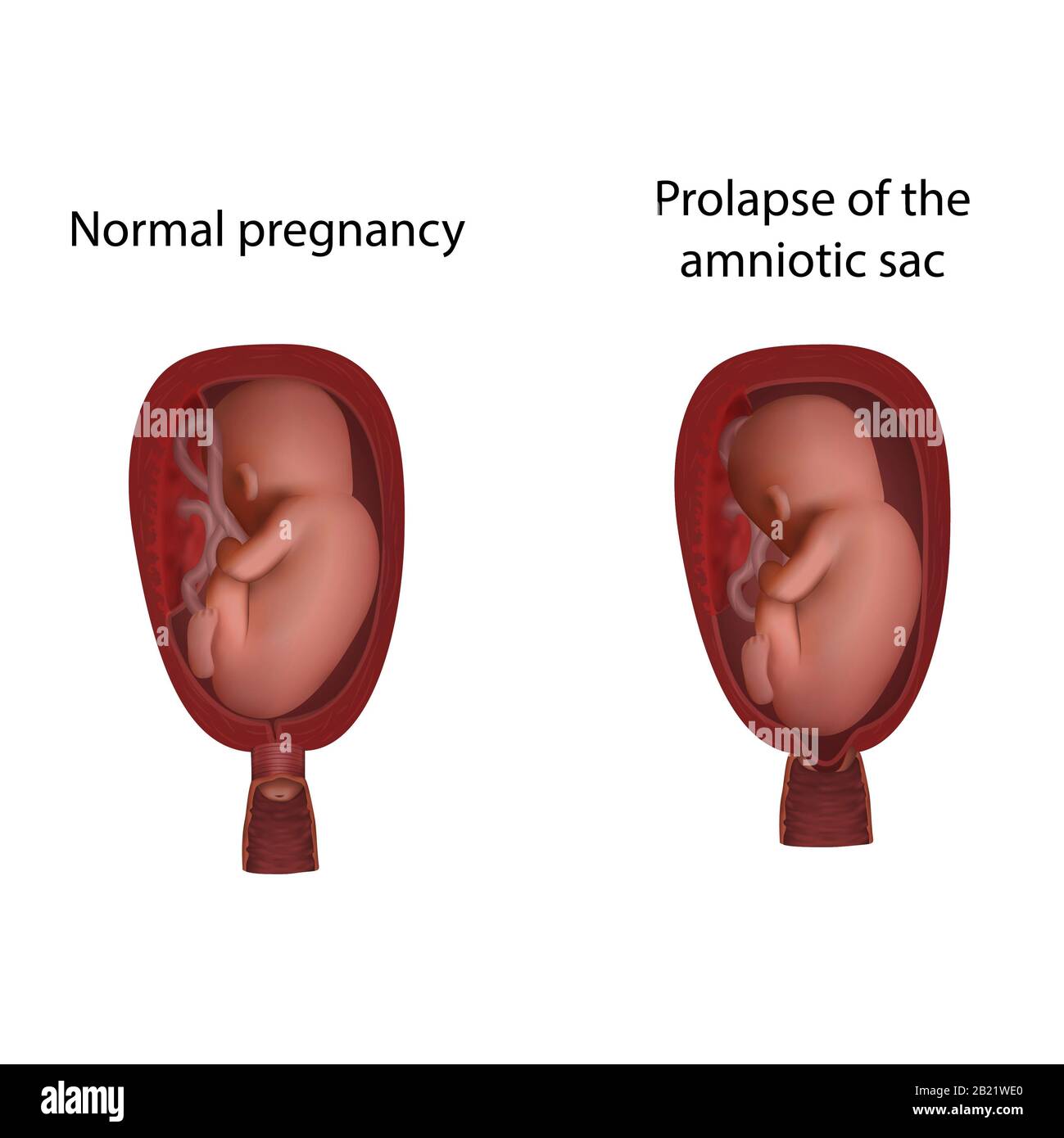 Sacco amniotico prolasso e gravidanza normale, illustrazione Foto Stock