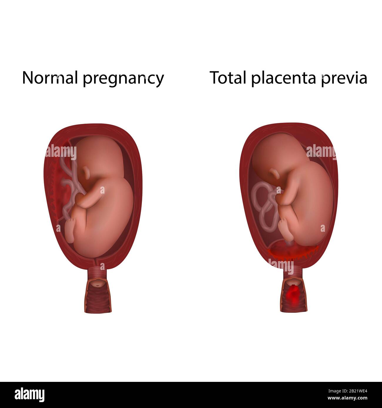 Placenta totale premia e gravidanza normale, illustrazione Foto Stock