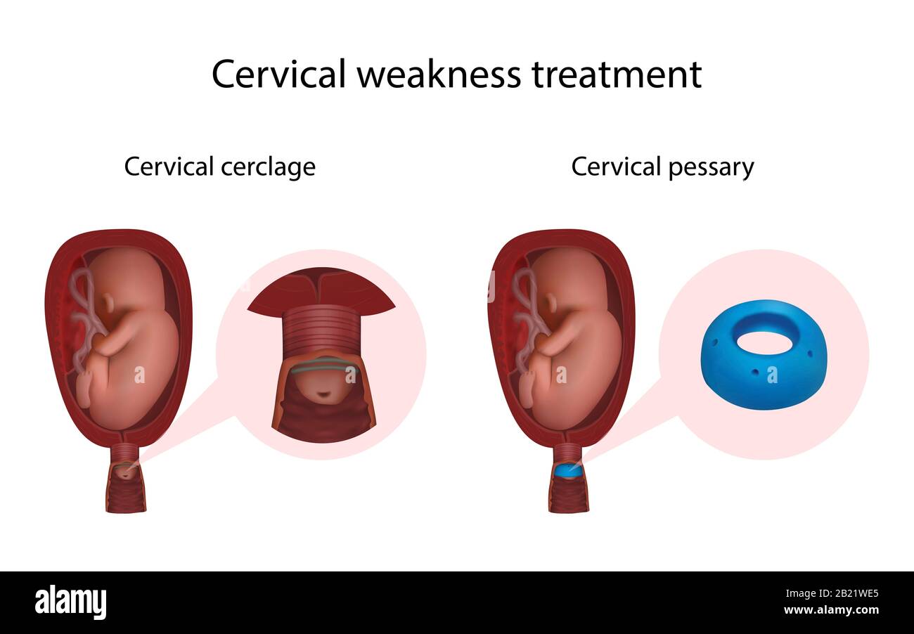 Debolezza cervicale, cerclage e pessary, illustrazione Foto Stock